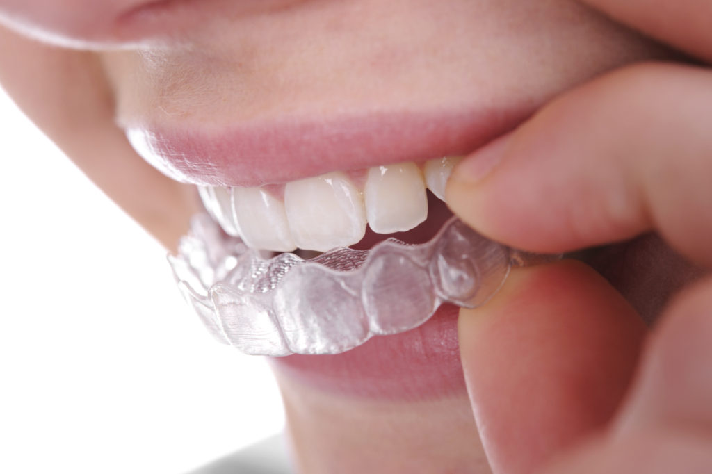 invisible braces - clear invisalign sunnyside dental