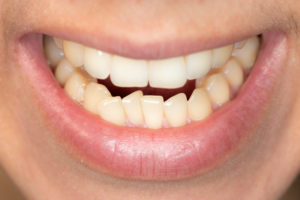 Smile with crowded crooked bottom teeth