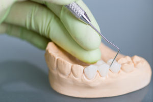 Dental bridge on plaster mold of teeth