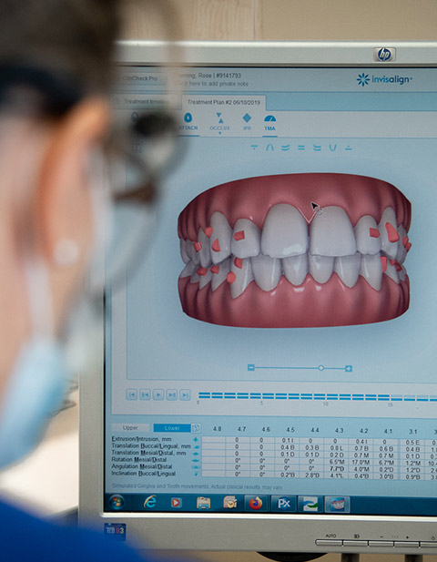 Digital Denture done with 3D Scanning