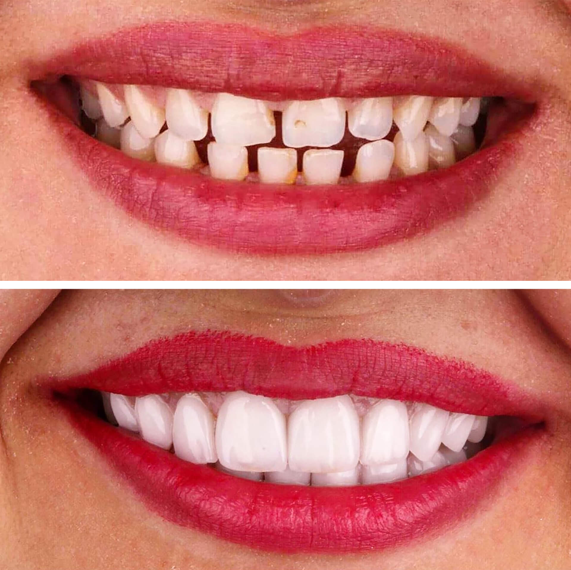 Before and after results of veneers